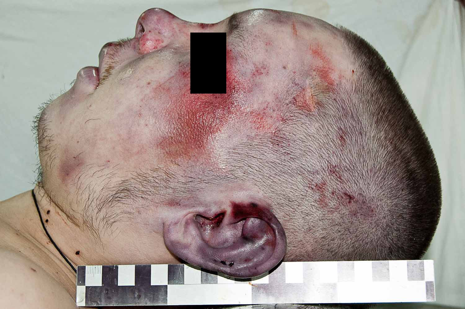 Жировая эмболия при переломе бедра