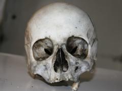 Foramina parietalia permagna (большие теменные отверстия)