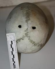 Foramina parietalia permagna (большие теменные отверстия)