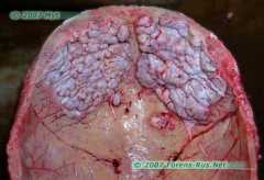 Hyperostosis Frontalis Interna