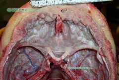 Hyperostosis Frontalis Interna