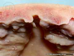 Hyperostosis