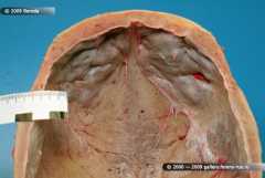 Hyperostosis