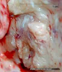 hyperostosis