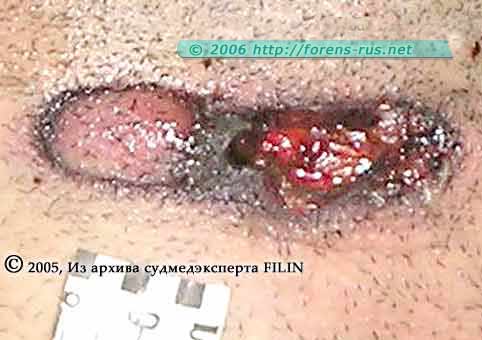 Самоубийство из двуствольного ружья