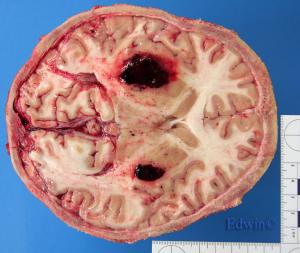 basal_ganglia.jpg