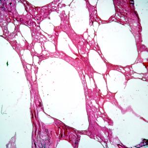 lung2.jpg