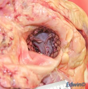 aortic_valve2.jpg