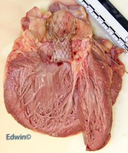 aortic_valve3.jpg