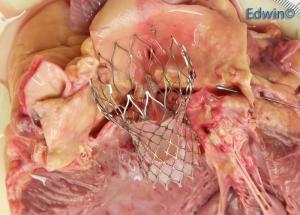 aortic_valve4.jpg