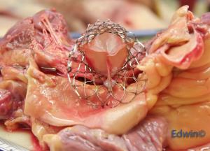 aortic_valve5.jpg