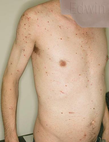 scabies1.jpg