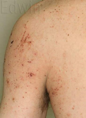 scabies2.jpg