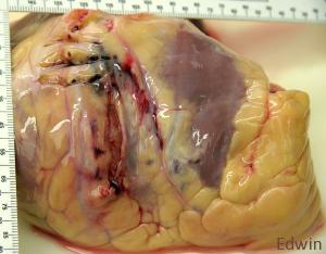 Cardiac_tamponade_2.jpg