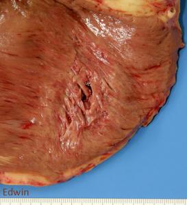 Cardiac_tamponade_1.jpg