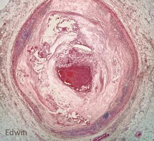 Cardiac_tamponade_3.jpg