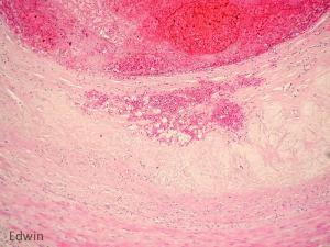 Cardiac_tamponade_4.jpg