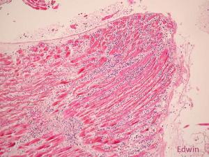 Cardiac_tamponade_5.jpg
