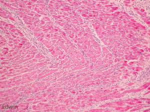 Cardiac_tamponade_6.jpg