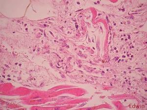 Cardiac_tamponade_7.jpg