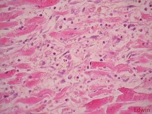 Cardiac_tamponade_8.jpg