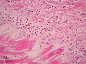 Cardiac_tamponade_9.jpg