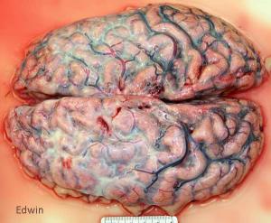 fibrose1.jpg