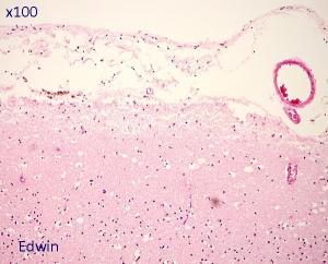 fibrose5.jpg