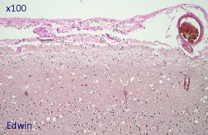 fibrose6.jpg