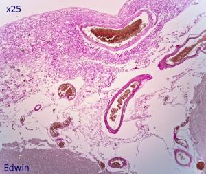 fibrose7.jpg