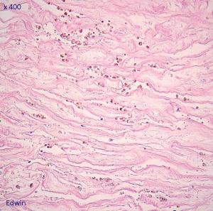 fibrose9.jpg
