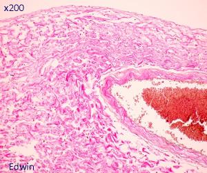 fibrose8.jpg
