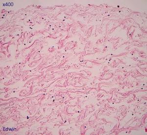 fibrose10.jpg