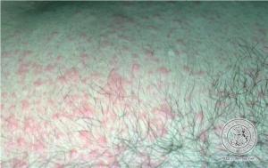urticaria.jpg