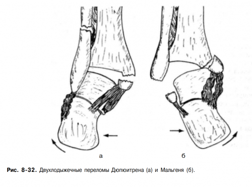 дюпюитрена перелом (2).png
