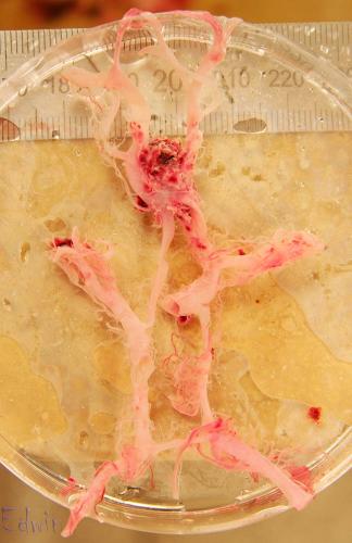aneurysma3.jpg