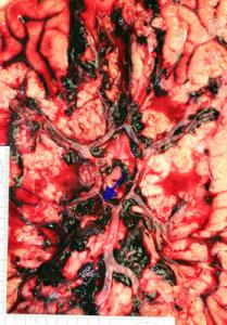 Aneurysma1A.jpg