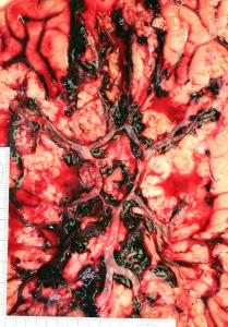 Aneurysma1.jpg