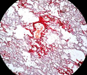 Lung_Fetembolism_3h_posttrauma2.jpg