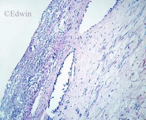 black_esophagus_3.jpg