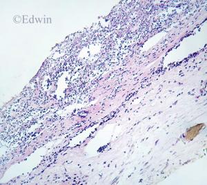 black_esophagus_4.jpg