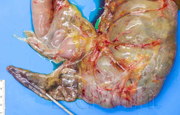 Appendizit.jpg