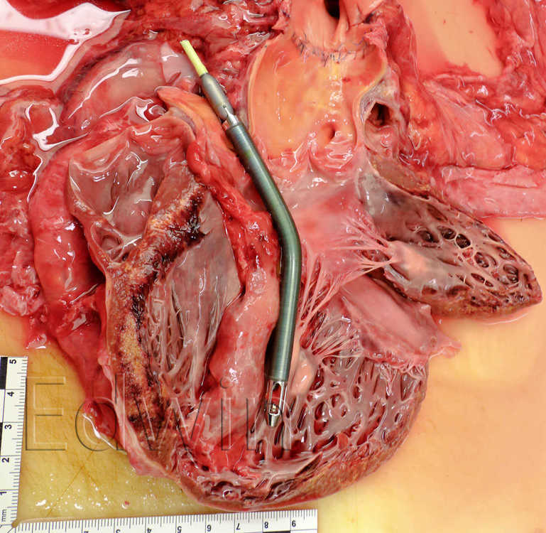 impella.jpg