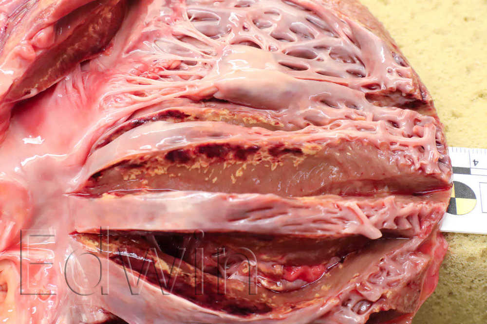 impella3.jpg