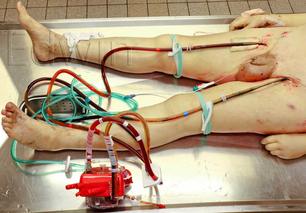 ECMO1.jpg