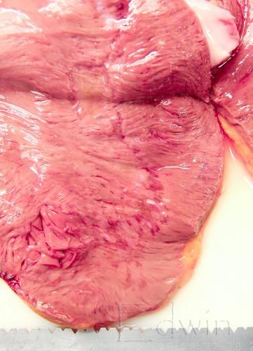 tamponade-2.jpg
