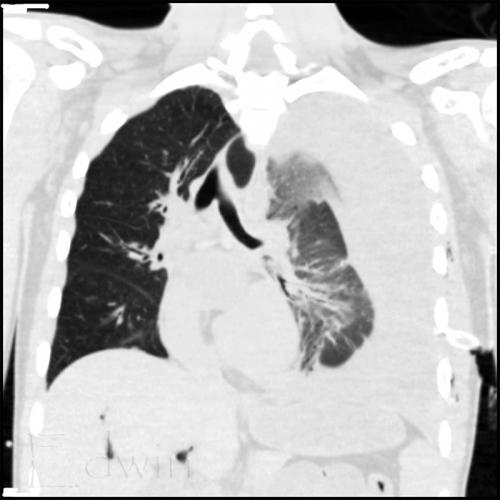 haemthorax1.jpg