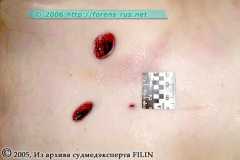 Внешний вид колото-резаных ран грудной клетки после отсепаровывания кожи