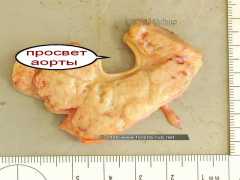 Лимфоузлы в окружности аорты