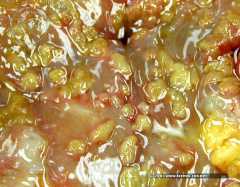 Псевдомембранозный колит